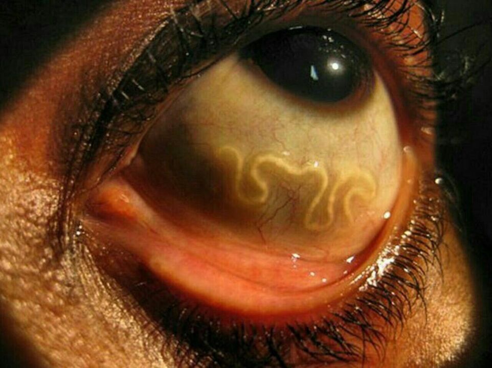 адам көзіндегі паразиттер